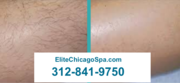 Permanent Laser Hair Removal in Chicago