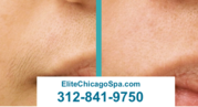 Lowest Laser Hair Removal Prices Chicago