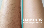 Laser Hair Removal Deals in Chicago